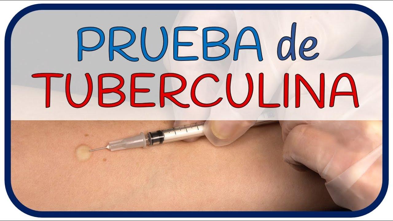 La prueba de Tuberculina: Un arma poderosa en la detección temprana de la Tuberculosis